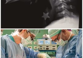 Salvato dai medici di Niguarda bimbo di 8 anni che rischiava di soffocare: aveva ingoiato una stella di metallo di 1,5 cm nella trachea