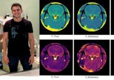 Lettura della risonanza magnetica in 10 secondi: la fondazione Mondino di Pavia inaugura il progetto pilota per le malattie neuromuscolari
