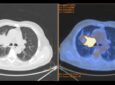 Noduli al polmone: prevenzione e screening per individuare precocemente eventuali patologie