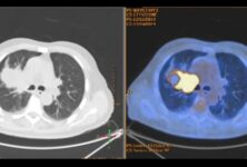 Noduli al polmone: prevenzione e screening per individuare precocemente eventuali patologie