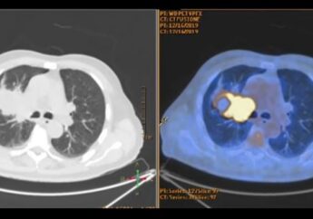 Noduli al polmone: prevenzione e screening per individuare precocemente eventuali patologie