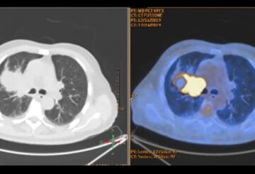 Noduli al polmone: prevenzione e screening per individuare precocemente eventuali patologie
